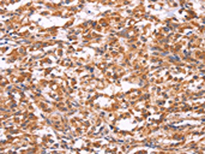 The image on the left is immunohistochemistry of paraffin-embedded Human thyroid cancer tissue using CSB-PA447792(EMP2 Antibody) at dilution 1/30, on the right is treated with synthetic peptide. (Original magnification: ×200)