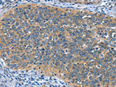The image on the left is immunohistochemistry of paraffin-embedded Human cervical cancer tissue using CSB-PA447859(DTX1 Antibody) at dilution 1/30, on the right is treated with synthetic peptide. (Original magnification: ×200)