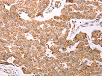 The image on the left is immunohistochemistry of paraffin-embedded Human breast cancer tissue using CSB-PA447966(SMAD5 Antibody) at dilution 1/20, on the right is treated with fusion protein. (Original magnification: ×200)