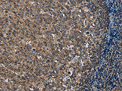 The image on the left is immunohistochemistry of paraffin-embedded Human tonsil tissue using CSB-PA448064(MMP20 Antibody) at dilution 1/40, on the right is treated with synthetic peptide. (Original magnification: ×200)