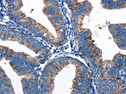 The image on the left is immunohistochemistry of paraffin-embedded Human cervical cancer tissue using CSB-PA448173(Gjc3 Antibody) at dilution 1/10, on the right is treated with synthetic peptide. (Original magnification: ×200)
