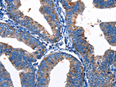The image on the left is immunohistochemistry of paraffin-embedded Human cervical cancer tissue using CSB-PA448173(Gjc3 Antibody) at dilution 1/10, on the right is treated with synthetic peptide. (Original magnification: ×200)