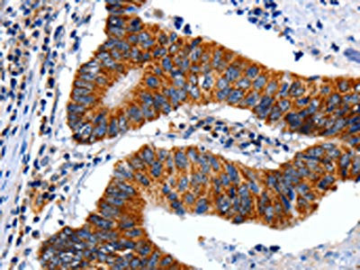The image on the left is immunohistochemistry of paraffin-embedded Human colon cancer tissue using CSB-PA448237(ENPP3 Antibody) at dilution 1/15, on the right is treated with synthetic peptide. (Original magnification: ×200)