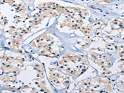 The image on the left is immunohistochemistry of paraffin-embedded Human thyroid cancer tissue using CSB-PA448323(CARD14 Antibody) at dilution 1/30, on the right is treated with fusion protein. (Original magnification: ×200)