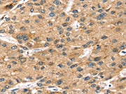 The image on the left is immunohistochemistry of paraffin-embedded Human liver cancer tissue using CSB-PA448728(SORT1 Antibody) at dilution 1/35, on the right is treated with synthetic peptide. (Original magnification: ×200)