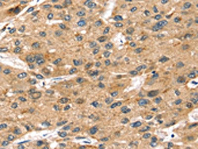 The image on the left is immunohistochemistry of paraffin-embedded Human liver cancer tissue using CSB-PA448728(SORT1 Antibody) at dilution 1/35, on the right is treated with synthetic peptide. (Original magnification: ×200)