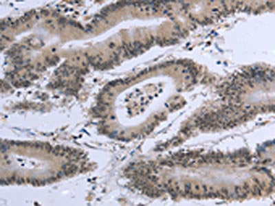 The image on the left is immunohistochemistry of paraffin-embedded Human colon cancer tissue using CSB-PA448901(EID1 Antibody) at dilution 1/20, on the right is treated with fusion protein. (Original magnification: ×200)