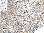 The image on the left is immunohistochemistry of paraffin-embedded Human lung cancer tissue using CSB-PA448902(TLK2 Antibody) at dilution 1/30, on the right is treated with fusion protein. (Original magnification: ×200)