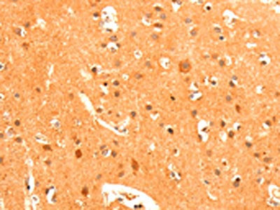 The image on the left is immunohistochemistry of paraffin-embedded Human brain tissue using CSB-PA449040(GRM3 Antibody) at dilution 1/50, on the right is treated with fusion protein. (Original magnification: ×200)