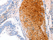 The image on the left is immunohistochemistry of paraffin-embedded Human cervical cancer tissue using CSB-PA449091(GRB10 Antibody) at dilution 1/25, on the right is treated with synthetic peptide. (Original magnification: ×200)