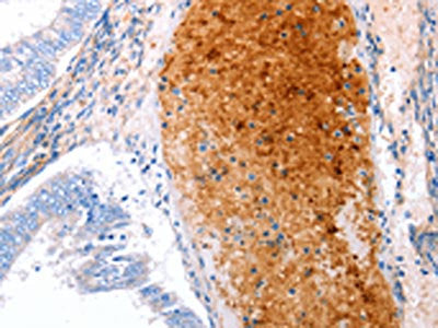 The image on the left is immunohistochemistry of paraffin-embedded Human cervical cancer tissue using CSB-PA449091(GRB10 Antibody) at dilution 1/25, on the right is treated with synthetic peptide. (Original magnification: ×200)