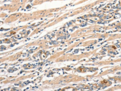 The image on the left is immunohistochemistry of paraffin-embedded Human gastic cancer tissue using CSB-PA449109(SLC41A2 Antibody) at dilution 1/30, on the right is treated with synthetic peptide. (Original magnification: ×200)