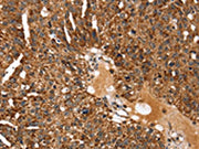 The image on the left is immunohistochemistry of paraffin-embedded Human breast cancer tissue using CSB-PA449173(KCNH6 Antibody) at dilution 1/30, on the right is treated with fusion protein. (Original magnification: ×200)