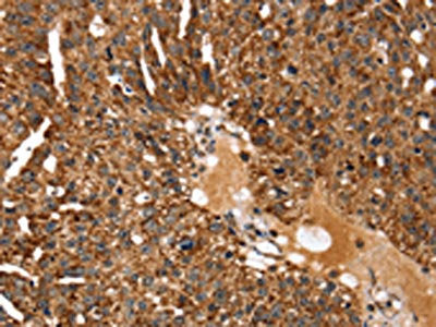 The image on the left is immunohistochemistry of paraffin-embedded Human breast cancer tissue using CSB-PA449173(KCNH6 Antibody) at dilution 1/30, on the right is treated with fusion protein. (Original magnification: ×200)