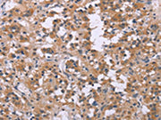 The image on the left is immunohistochemistry of paraffin-embedded Human thyroid cancer tissue using CSB-PA449267(FGFR2 Antibody) at dilution 1/20, on the right is treated with synthetic peptide. (Original magnification: ×200)