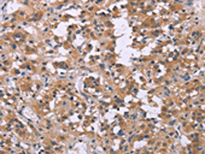 The image on the left is immunohistochemistry of paraffin-embedded Human thyroid cancer tissue using CSB-PA449267(FGFR2 Antibody) at dilution 1/20, on the right is treated with synthetic peptide. (Original magnification: ×200)