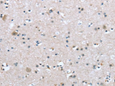 The image on the left is immunohistochemistry of paraffin-embedded Human brain tissue using CSB-PA449302(TRPM3 Antibody) at dilution 1/20, on the right is treated with synthetic peptide. (Original magnification: ×200)