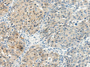 The image on the left is immunohistochemistry of paraffin-embedded Human breast cancer tissue using CSB-PA449379(TBXA2R Antibody) at dilution 1/45, on the right is treated with synthetic peptide. (Original magnification: ×200)