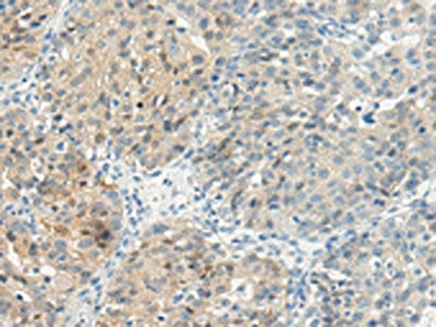 The image on the left is immunohistochemistry of paraffin-embedded Human breast cancer tissue using CSB-PA449379(TBXA2R Antibody) at dilution 1/45, on the right is treated with synthetic peptide. (Original magnification: ×200)
