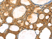 The image on the left is immunohistochemistry of paraffin-embedded Human thyroid cancer tissue using CSB-PA449408(TMPRSS11F Antibody) at dilution 1/30, on the right is treated with synthetic peptide. (Original magnification: ×200)