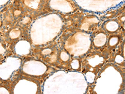 The image on the left is immunohistochemistry of paraffin-embedded Human thyroid cancer tissue using CSB-PA449408(TMPRSS11F Antibody) at dilution 1/30, on the right is treated with synthetic peptide. (Original magnification: ×200)