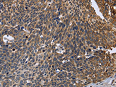 The image is immunohistochemistry of paraffin-embedded Human cervical cancer tissue using CSB-PA449695(GABPB2 Antibody) at dilution 1/30. (Original magnification: ×200)