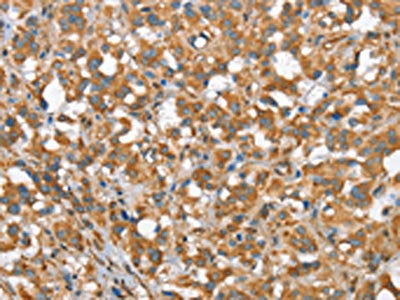 The image on the left is immunohistochemistry of paraffin-embedded Human thyroid cancer tissue using CSB-PA449858(CSMD1 Antibody) at dilution 1/40, on the right is treated with synthetic peptide. (Original magnification: ×200)