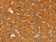 The image on the left is immunohistochemistry of paraffin-embedded Human liver cancer tissue using CSB-PA449923(RGS4 Antibody) at dilution 1/25, on the right is treated with fusion protein. (Original magnification: ×200)