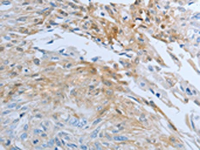 The image on the left is immunohistochemistry of paraffin-embedded Human esophagus cancer tissue using CSB-PA449957(FGF1 Antibody) at dilution 1/25, on the right is treated with synthetic peptide. (Original magnification: ×200)