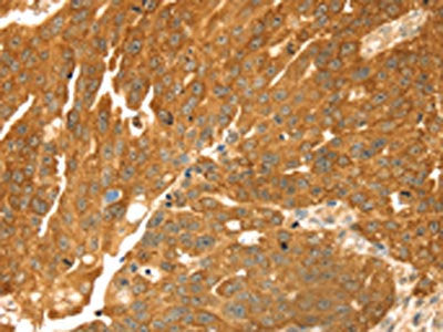 The image on the left is immunohistochemistry of paraffin-embedded Human breast cancer tissue using CSB-PA451608(TMEFF2 Antibody) at dilution 1/35, on the right is treated with synthetic peptide. (Original magnification: ×200)
