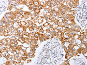 The image on the left is immunohistochemistry of paraffin-embedded Human breast cancer tissue using CSB-PA454097(TNFAIP1 Antibody) at dilution 1/25, on the right is treated with fusion protein. (Original magnification: ×200)