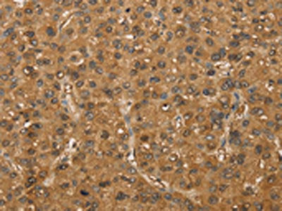 The image on the left is immunohistochemistry of paraffin-embedded Human liver cancer tissue using CSB-PA458397(SETD2 Antibody) at dilution 1/30, on the right is treated with fusion protein. (Original magnification: ×200)