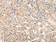 The image on the left is immunohistochemistry of paraffin-embedded Human breast cancer tissue using CSB-PA459673(USP47 Antibody) at dilution 1/20, on the right is treated with fusion protein. (Original magnification: ×200)