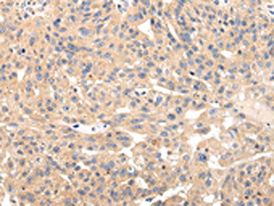 The image on the left is immunohistochemistry of paraffin-embedded Human breast cancer tissue using CSB-PA459673(USP47 Antibody) at dilution 1/20, on the right is treated with fusion protein. (Original magnification: ×200)
