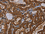 The image on the left is immunohistochemistry of paraffin-embedded Human thyroid cancer tissue using CSB-PA460709(LRRC57 Antibody) at dilution 1/40, on the right is treated with fusion protein. (Original magnification: ×200)