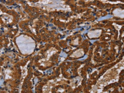 The image on the left is immunohistochemistry of paraffin-embedded Human thyroid cancer tissue using CSB-PA460709(LRRC57 Antibody) at dilution 1/40, on the right is treated with fusion protein. (Original magnification: ×200)
