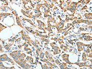 The image on the left is immunohistochemistry of paraffin-embedded Human breast cancer tissue using CSB-PA461581(AGR3 Antibody) at dilution 1/10, on the right is treated with fusion protein. (Original magnification: ×200)