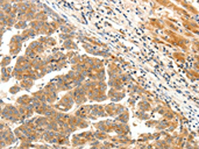 The image on the left is immunohistochemistry of paraffin-embedded Human liver cancer tissue using CSB-PA463798(LPAR5 Antibody) at dilution 1/25, on the right is treated with synthetic peptide. (Original magnification: ×200)
