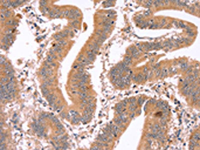 The image on the left is immunohistochemistry of paraffin-embedded Human colon cancer tissue using CSB-PA468797(ICAM5 Antibody) at dilution 1/20, on the right is treated with synthetic peptide. (Original magnification: ×200)