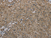 The image on the left is immunohistochemistry of paraffin-embedded Human esophagus cancer tissue using CSB-PA469305(CLPS Antibody) at dilution 1/45, on the right is treated with fusion protein. (Original magnification: ×200)