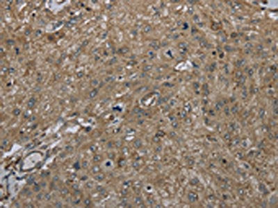 The image on the left is immunohistochemistry of paraffin-embedded Human esophagus cancer tissue using CSB-PA469305(CLPS Antibody) at dilution 1/45, on the right is treated with fusion protein. (Original magnification: ×200)