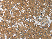 The image on the left is immunohistochemistry of paraffin-embedded Human breast cancer tissue using CSB-PA475447(PXN Antibody) at dilution 1/30, on the right is treated with synthetic peptide. (Original magnification: ×200)