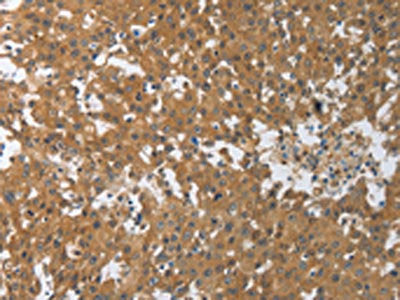 The image on the left is immunohistochemistry of paraffin-embedded Human breast cancer tissue using CSB-PA475447(PXN Antibody) at dilution 1/30, on the right is treated with synthetic peptide. (Original magnification: ×200)