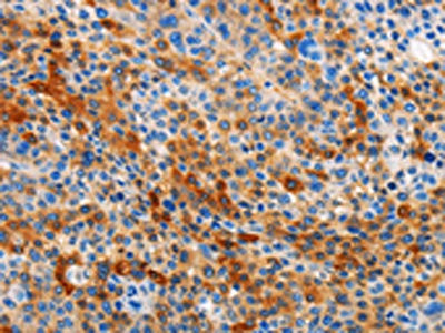 The image on the left is immunohistochemistry of paraffin-embedded Human liver cancer tissue using CSB-PA477062(STAMBP Antibody) at dilution 1/15, on the right is treated with fusion protein. (Original magnification: ×200)