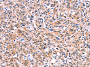 The image on the left is immunohistochemistry of paraffin-embedded Human esophagus cancer tissue using CSB-PA477402(BMPR2 Antibody) at dilution 1/35, on the right is treated with fusion protein. (Original magnification: ×200)