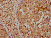 IHC image of CSB-PA4779A0Rb diluted at 1:400 and staining in paraffin-embedded human breast cancer performed on a Leica BondTM system. After dewaxing and hydration, antigen retrieval was mediated by high pressure in a citrate buffer (pH 6.0). Sect...