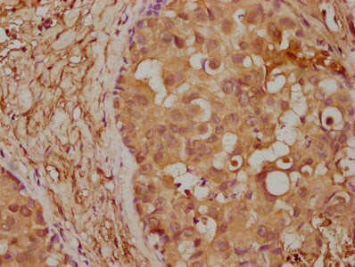 IHC image of CSB-PA4779A0Rb diluted at 1:400 and staining in paraffin-embedded human breast cancer performed on a Leica BondTM system. After dewaxing and hydration, antigen retrieval was mediated by high pressure in a citrate buffer (pH 6.0). Sect...