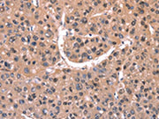 The image on the left is immunohistochemistry of paraffin-embedded Human liver cancer tissue using CSB-PA480274(EXTL1 Antibody) at dilution 1/20, on the right is treated with synthetic peptide. (Original magnification: ×200)