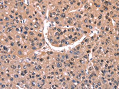 The image on the left is immunohistochemistry of paraffin-embedded Human liver cancer tissue using CSB-PA480274(EXTL1 Antibody) at dilution 1/20, on the right is treated with synthetic peptide. (Original magnification: ×200)