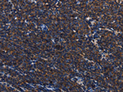 The image on the left is immunohistochemistry of paraffin-embedded Human Lymphoma tissue using CSB-PA480713(PTPRC Antibody) at dilution 1/40, on the right is treated with synthetic peptide. (Original magnification: ×200)